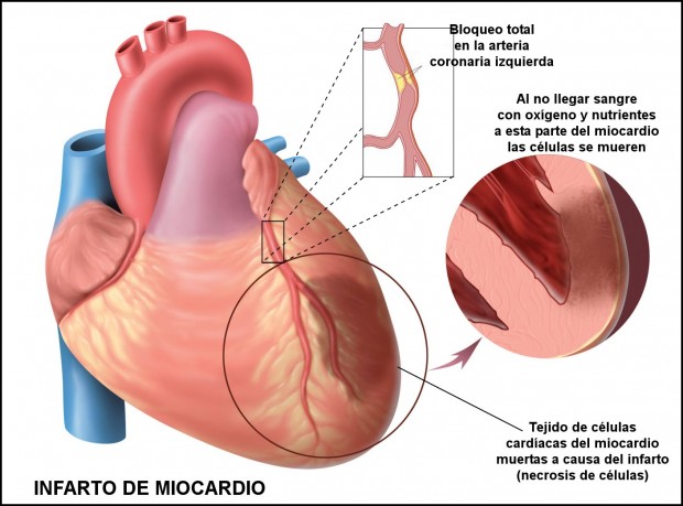 Infarto Miocardio